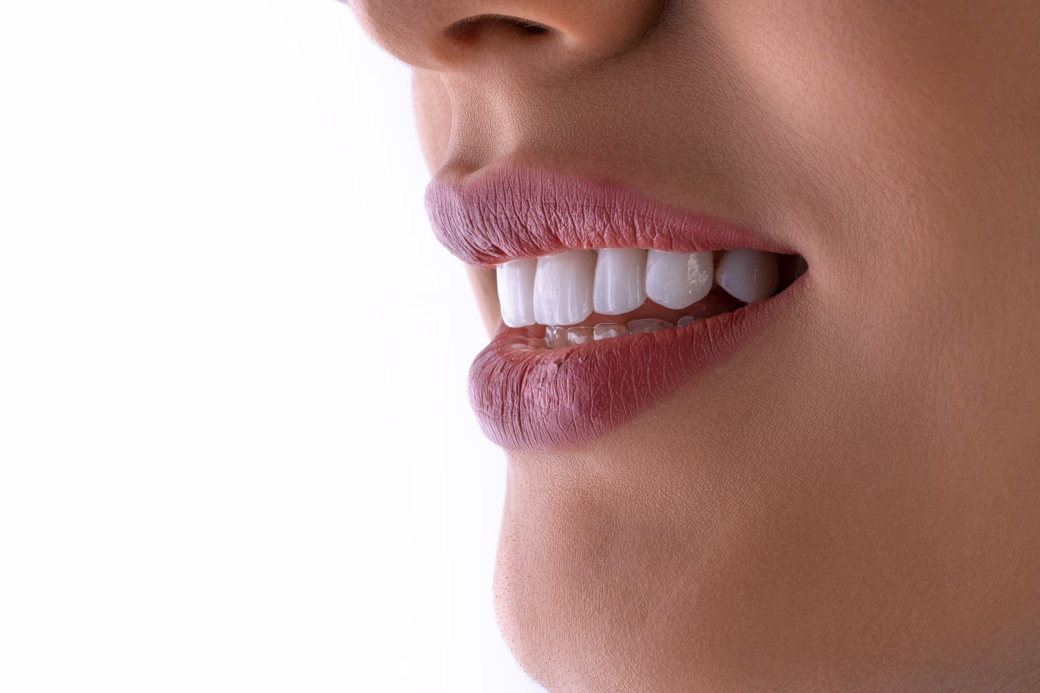 Veneers vs. Bonding: Which Is Right for You?