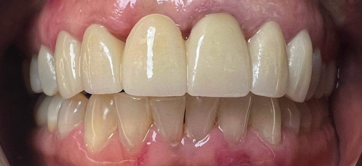 What Happens If You Don't Replace a Missing Tooth?