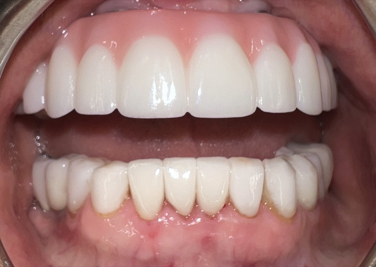 Teeth Whitening in Midtown Manhattan: What to Expect